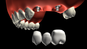 dentists-marketing-dental-video-Fixed-Partial-Denture-Screwed-on-Implant-Dental-3d-animation