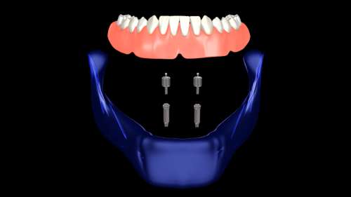 Materials | Free Full-Text | New Dental Implant with 3D Shock Absorbers and  Tooth-Like Mobility—Prototype Development, Finite Element Analysis (FEA),  and Mechanical Testing
