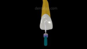 image for dentists marketing endodontic treatment