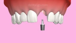 image of abutment of cone morse dental implant
