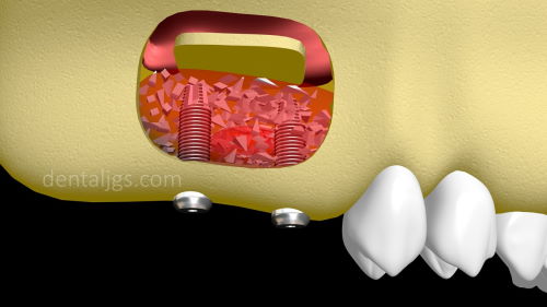 Image-of-sinus-lift-with-dental-implants-installed